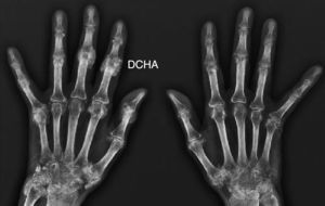 Calcificaciones periarticulares amorfas con contornos polilobulados sin destrucción ósea en distintas áreas articulares.