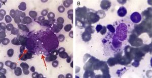 Detalle del histiocito con citoplasma vacuolado fagocitando una célula hematopoyética.
