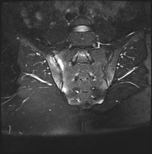 Sacroiliac joints MRI showed bilateral sacroiliitis.