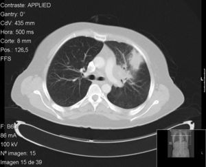 TC pulmonar. Condensación en el lóbulo superior izquierdo que contacta con pleura costal anterior y se acompaña de adenopatías hiliares ipsolaterales.