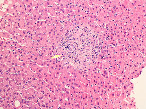Biopsia hepática. Granuloma lobulillar no necrosante (flecha) en el seno de parénquima hepático sin alteraciones de su arquitectura.