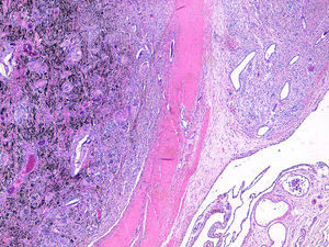 Biopsia sinovial: pigmento negruzco infiltrando la sinovial.