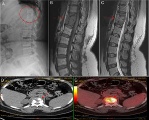 A) En el estudio radiológico se objetiva rarefacción ósea de los cuerpos vertebrales D11 y D12 con una gran erosión en su margen anterior. B) En el estudio de resonancia magnética se objetiva una lesión y colección lobulada que compromete a D11, D12 y su respectivo disco intervertebral (flecha continua) que es hipointenso en T1. C) Estudio de resonancia magnética que es hiperintenso en T2. D y E) En el estudio de la tomografía por emisión de positrones se comprueba la alta actividad metabólica de las lesiones (flecha discontinua).