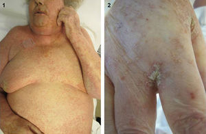 1) Placas hiperqueratósicas y numerosas lesiones lineales distribuidas en tronco, con predominio en área facial y mamas. 2) Placas hiperqueratósicas y lesiones lineales en dorso de manos, predominando en pliegues interdigitales.