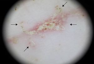 Dermatoscopia; se visualizan estructuras parduzcas, en forma de «ala delta» en el extremo de los surcos (flechas).