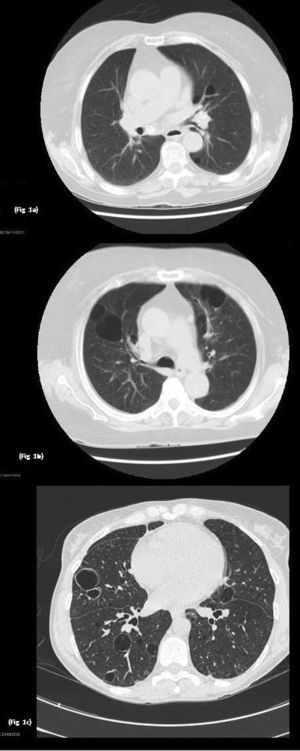 Imágenes TACAR: a) Se observa enfisema centrolobulillar e imágenes quísticas; b) Lesiones pulmonares quísticas bilaterales, algunas de ellas con septos en su interior, bronquiectasias por tracción en ambos lóbulos inferiores, áreas de enfisema pulmonar centrolobulillar y paraseptal y tractos fibróticos, y c) Se evidencian múltiples imágenes quísticas pulmonares de pared fina bilaterales.