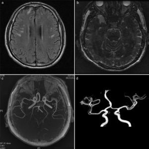 a) IRM en secuencia T1 con imágenes hiperintensas de daño microvascular en sustancia blanca de lóbulos frontales y parietales bilaterales; b) IRM secuencia de inversión recuperación, con lesiones en lóbulo temporal derecho; c) Angiorresonancia magnética mostrando circulación cerebral anterior sin afección de grandes vasos; d) Angiorresonancia con polígono de Willis normal.