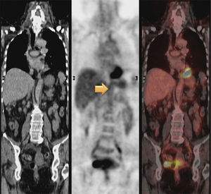 PET/TC con 18F-fluordeoxiglucosa: captación anómala de FDG en el trayecto de la aorta torácica y abdominal en su pared. Se observa afectación del arco aórtico de la aorta descendente torácica y, también, de la arteria pulmonar. Incremento de FDG en toda la extensión de la aorta abdominal que afecta la AMS y que se extiende hasta la bifurcación iliaca común. Presencia de focos de ateromatosis calcificada.