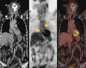 PET/TC con 18F-fluordeoxiglucosa: captación anómala de FDG en el trayecto de la aorta torácica y abdominal en su pared. Se observa afectación del arco aórtico de la aorta descendente torácica y, también, de la arteria pulmonar. Incremento de FDG en toda la extensión de la aorta abdominal que afecta la AMS y que se extiende hasta la bifurcación iliaca común. Presencia de focos de ateromatosis calcificada.
