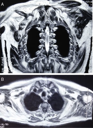 A) y B) RNM donde se evidencia atrofia y reemplazamiento con tejido graso en la musculatura de la cintura escapular de manera bilateral, aunque con predominio en el lado derecho.