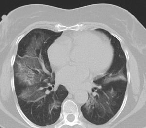 HRCT. Peribronchial ground glass compatible with OP.