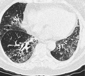HRCT. Bilateral interstitial involvement with ground glass areas and established fibrosis with traction bronchiectasis, without honey combing, compatible with fibrosing NSIP.