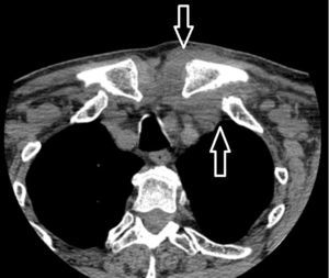 Aumento de partes blandas, y borramiento de planos grasos, con relación al proceso inflamatorio-infeccioso de la articulación esternoclavicular izquierda (flechas).