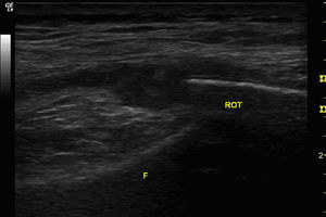 Ecografía de la rodilla derecha. Vista longitudinal del receso parapatelar externo. Se aprecia importante proliferación sinovial de aspecto homogéneo. F: cortical del fémur inmediatamente proximal al cóndilo femoral externo; ROT: cortical superficial del borde externo de la rótula.