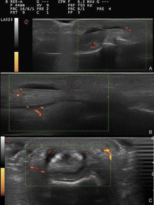 Imágenes ecográficas del cuarto dedo de la mano derecha. A) Eje largo: falange media-distal, con señal power Doppler grado 1. B) Eje largo: metacarpo-falange proximal, con señal power Doppler grado 2. C) Posición transversal metacarpo-falange proximal, con señal power Doppler grado 2.