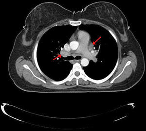 Torax CT showed bilateral hilar and mediastinal lymphadenopathy.