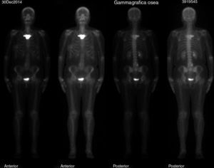 Gammagrafía. Lesión blástica difusa en manubrio esternal.