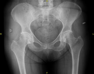 Rx de cadera.