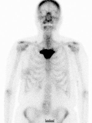 TC de tórax. Esclerosis en manubrio esternal.