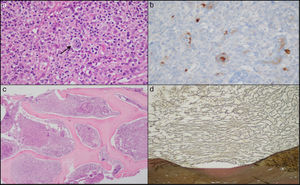 a) Ganglio linfático con distorsión de la arquitectura a expensas de una proliferación de células grandes de tipo Reed Sternberg (flecha), con presencia de linfocitos, eosinófilos y células plasmáticas (HE). b) Con tinción de inmunohistoquímica, se observa positividad CD15 de membrana y paranuclear en las células neoplásicas. c) Médula ósea a bajo aumento, donde es posible observar un marcado aumento de la celularidad de los espacios medulares, cercano al 100% (HE). d) Médula ósea con marcado aumento de la trama reticular (tinción de reticulina).