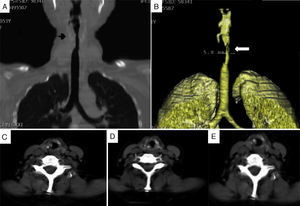 Tomografía computarizada laringotraqueal del caso 2. A) Se observa una estenosis subglótica (flecha). B) Reconstrucción 3D de la estenosis subglótica (flecha). C-E) En los cortes axiales se aprecia una lesión granulomatosa (*) que obstruye parcialmente la luz traqueal.