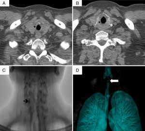Tomografía computarizada laringotraqueal del caso 3. A y B) En los cortes axiales se aprecia la existencia de una estenosis subglótica con engrosamiento concéntrico circunferencial de la mucosa (*) que obstruye parcialmente la luz traqueal. C) Se observa una estenosis subglótica (flecha). D) Reconstrucción volumétrica estenosis subglótica (flecha).