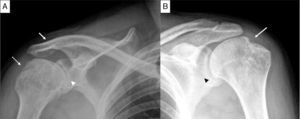 Proyección AP de hombro. A) En el hombro derecho se aprecian erosiones en la tuberosidad mayor (flecha punteada), disminución del espacio glenohumeral (cabeza de flecha) y la anquilosis de la articulación acromioclavicular (flecha). B) En el hombro izquierdo se aprecia disminución del espacio glenohumeral (cabeza de flecha) y el signo del hachazo (flecha).