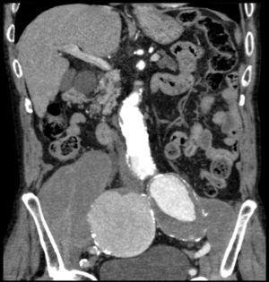 TC abdominopélvica. Corte coronal. Aneurismas aislados ilíacos bilaterales de gran tamaño.