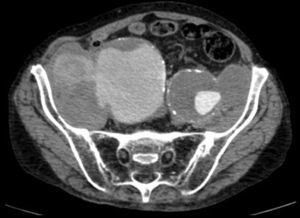 TC. Corte axial. Rotura contenida de aneurisma de arteria ilíaca común derecha. Hematoma extraadventicial con signos de organización en su pared que limita con estructuras vecinas. El hematoma tiene continuidad con la luz a modo de seudoaneurisma.