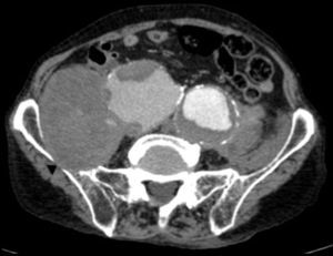 TC pelvis. Hueso ilíaco derecho horadado (punta de flecha).