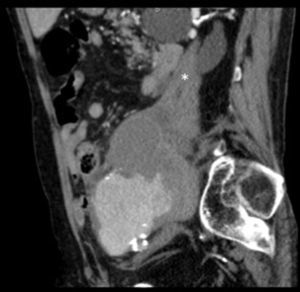 TC abdominopélvica. Corte sagital. Hematoma cronificado situado en el espacio del psoas (asterisco).