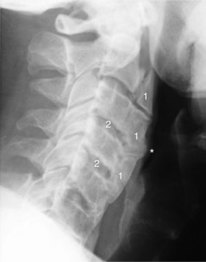 Radiografía cervical lateral (2014). Se aprecia un aumento del tamaño de la osificación del ligamento anterior cervical con afectación global de la columna cervical (1) se puede observar como impronta (*) hacia la vía aérea-digestiva. También se observa una conservación relativa de la altura del espacio intervertebral (2).