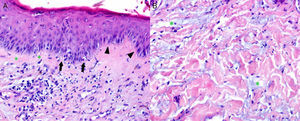 A) Epidermis con degeneración vacuolar de la basal (asterisco), queratinocitos necróticos aislados (flecha) e infiltrado linfocitario discreto asociado. Se observa verticalización de las células de la capa basal (cabeza de flecha), rasgo histológico asociado con frecuencia a eritema multiforme. Infiltrados linfoplasmocitarios y melanófagos en dermis papilar. B) Dermis reticular con infiltración intersticial de mucina ácida (asterisco).