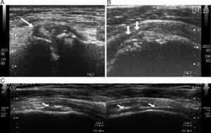 A) Derrame articular y calcificaciones en la articulación acromioclavicular. B) Calcificaciones del cartílago humeral (condrocalcinosis). C) Erosiones subcondrales y rotura subaguda-crónica de la porción anterior del supraespinoso (adelgazamiento tendinoso a la compresión).