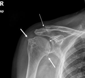 Osteofitosis de la cabeza humeral en relación con cambios degenerativos en la articulación glenohumeral (flechas gruesas). Calcificación de la articulación acromioclavicular y del cartílago humeral (flechas finas). No se observan calcificaciones tendinosas ni pinzamiento subacromial.