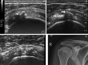 Artropatía por depósito de hidroxiapatita. (a) Calcificaciones intratendinosas (ver flecha). (b) Calcificación en suelo de bolsa subacromial. (c) Pequeñas calcificaciones en porción anterior del SE y una de ellas (ver flecha) en el interior de bolsa subacromial). (d) Calcificación tendinosas del supraespinoso en radiografía simple.