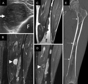 A) Imagen axial de la ecografía del muslo, que muestra una tumoración de partes blandas intramuscular, hipoecogénica y heterogénea (flecha), compatible con lesión sólida. B-D) Cortes coronales de la RM del muslo, que muestran la tumoración intramuscular bien definida marcadamente hiperintensa en la secuencia STIR (punta de flecha en B), hipointensa en T1 (flecha en C) y con realce heterogéneo tras la administración de gadolinio IV en la secuencia T1 poscontraste, con saturación de la grasa (punta de flecha en D), compatible con mixoma. Se visualizan también las lesiones óseas en el fémur con realce difuso tras la administración de contraste. E) Corte coronal de la TC del fémur con ventana ósea, que muestra las lesiones óseas con aumento de densidad y un patrón «en vidrio deslustrado» típico de la displasia fibrosa (flechas pequeñas). F: fémur; STIR: Short Tau Inversion Recovery.