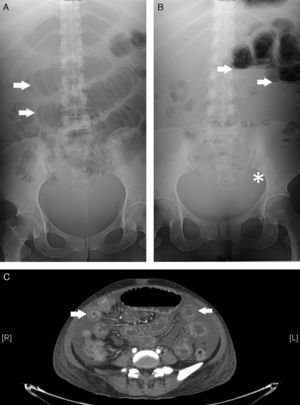 Panel A muestra asas de intestino delgado dilatadas con el signo de “pila de monedas” (flechas). Panel B se observa las asas intestinales con niveles hidro-aéreos (flechas) al igual que la ausencia de gas distal (asterisco). Panel C se observan múltiples imágenes en “tiro al blanco” a lo largo de todo el intestino delgado.