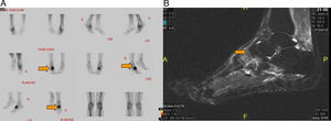 A) Gammagrafía ósea con Tc99, que muestra lesión intensa en región cuneo-escafoidea del tarso derecho. B) RM sagital en secuencia STIR con aumento de señal. Más evidente a nivel de cuneiforme intermedio y lateral derecho.