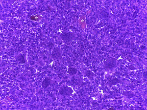 Histopatología de la lesión en el cuerpo vertebral de C2 demostrando que la médula ósea ha sido reemplazada por una proliferación de células mononucleares redondeadas o fusiformes y células gigantes multinucleadas tipo osteoclasto (cabezas de flecha). Se observan algunas trabéculas óseas residuales entre las células tumorales (asteriscos) (hematoxilina y eosina, aumento original 20×).
