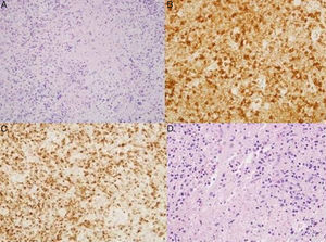 A) Hematoxilina-eosina: ganglio linfático cervical. Linfocitos con áreas de necrosis en diferentes etapas de maduración. B) Ganglio linfático cervical. Presencia de linfocitos con expresión CD8 en relación con áreas de necrosis. C) Ganglio linfático cervical. Presencia de linfocitos con expresión TIA1 en relación con áreas de necrosis. D) Ganglio linfático supraclavicular. Hematoxilina-eosina: linfocitos con áreas de necrosis en diferentes etapas de maduración.