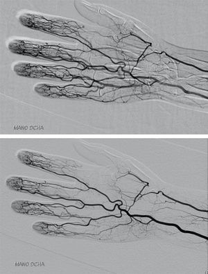 Oclusión de la arteria radial derecha a nivel de la tabaquera anatómica.