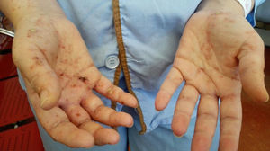 Lesiones vesículo-papulosas difusas en región palmar de manos.