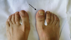 Exploración física de ambos pies. Puede verse, en el primer dedo del pie derecho, onicodistrofia, dactilitis y eritema periungueal (flecha).