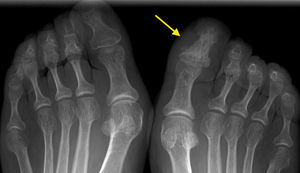 Radiografía anteroposterior de ambos pies. La falange distal del primer dedo del pie derecho muestra una esclerosis global con apariencia de «marfil» (flecha).