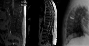 RNM de la columna dorso-lumbar: se aprecia disminución de altura de cuerpos vertebrales dorsales y lumbares. El cuerpo vertebral D7 está notablemente disminuido de altura y presenta alteración en la intensidad de la señal. Hay cambios similares pero menos notorios en el borde superior de D11 y L2. Rx lateral de la columna dorsal: vertebroplastia a nivel de D7.