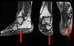 RMN secuencia T1: véase atrofia con reemplazamiento graso del músculo abductor del quinto dedo, y múltiples venas dilatadas o varicosidades en la cara interna del pie, en el recorrido del nervio calcáneo inferior, lo que sugiere neuropatía compresiva de Baxter.