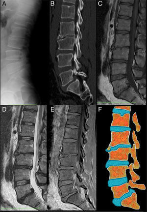 Vértebra limbus: a) Radiografía lateral de columna lumbar. Se aprecia irregularidad de la esquina superior y anterior del cuerpo vertebral L3. El espacio intervertebral L2-L3 se encuentra estrechado. Se observan pequeñas formaciones osteofitarias anteriores en L2 y L4. La densidad de los cuerpos vertebrales se conserva; b) TC con reconstrucción MPR sagital, donde se observan con mayor detalle la irregularidad del borde súpero-anterior del cuerpo L3, apreciándose esclerosis tanto en el platillo vertebral hundido como en los contornos del fragmento óseo separado del resto del hueso. También se observa una listesis L5-S1 y una hernia de Schmorl en el platillo superior de L1; c) RM secuencia SET1 en el plano sagital. La intensidad de los cuerpos vertebrales está conservada y el fragmento óseo separado del cuerpo L3 presenta la misma intensidad de señal que el resto del hueso; d) RM secuencia SET2 en el plano sagital. Los hallazgos complementan lo observado en la secuencia SET1. Se observa disminución de altura y señal de los discos intervertebrales L2-L3, L3-L4 y L5-S1 en relación con deshidratación en el contexto de una discopatía degenerativa. En L5-S1 se observa, también, una hernia discal posterocentral migrada cranealmente, acompañando a la listesis; e) Secuencias de RM en el plano sagital SET1 en fase y fase opuesta. En estas secuencias la señal del cartílago discal es alta y brillante. Se puede apreciar cómo se introduce entre el fragmento óseo y la región más anterior del platillo superior de L3, y f) Esquema que representa los cambios observados en las imágenes de la izquierda. Nótese como el disco intervertebral L2-L3 se introduce a través de la superficie anterior del cuerpo vertebral L3. También se puede ver una herniación de Schmorl en el platillo superior de L1 y una protrusión global del disco L5-S1 con hernia discal posterocentral acompañando a la listesis L5-S1.