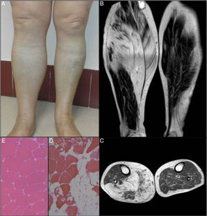 A) Aumento del volumen de la pierna derecha. B) y C) RMN longitudinal y transversal de ambos miembros inferiores. D) Biopsia muscular del paciente (hemotoxilina-eosina ×10). E) Comparativa con una biopsia muscular normal de gemelo interno (×10).