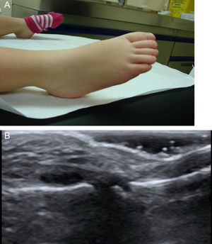 A) Artritis de interfalángica proximal (IFP) de pie derecho. B) Exploración ecográfica complementaria de dicha IFP de pie derecho.